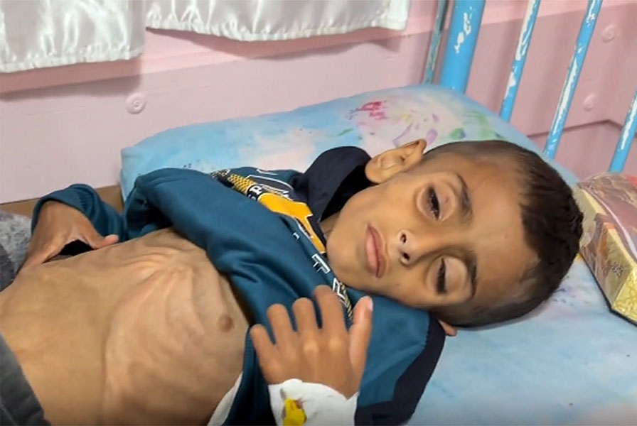 O menino Ossama Al-Raqab, de apenas cinco anos, se encontra à beira da morte no Hospital Nasser, parcialmente bombardeado pelos israelenses (Reprodução)